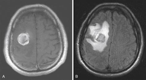 Metastatic Brain Tumors Neupsy Key