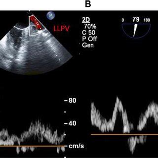 Two Dimensional Transesophageal Echocardiography Midesophageal