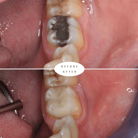 Composite Bonding In Sydney Composite Dental Bonding