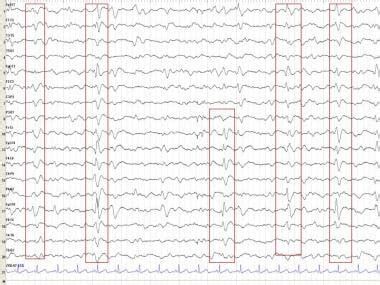 What EEG Findings Are Characteristic Of Creutzfeldt Jakob Disease CJD