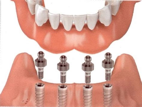 Cirujano Oral Est Tica Y Armonizaci N Casos Sobredentadura Con