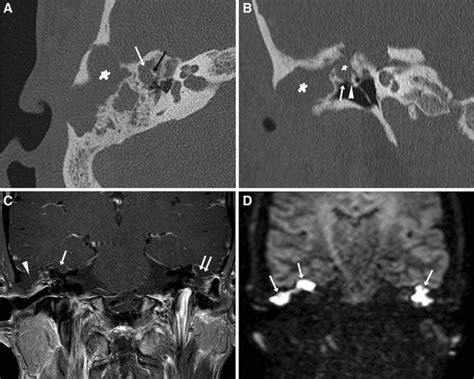 Acquired Cholesteatoma A Axial Ct Image Of The Right Temporal Bone