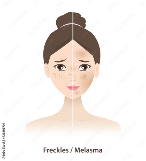 Comparison Of Freckles And Melasma On Skin Woman Face Vector