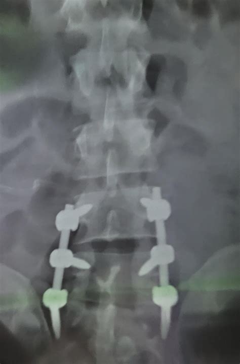 Healing stages of my spinal fixation and decompression : r/MedicalGore