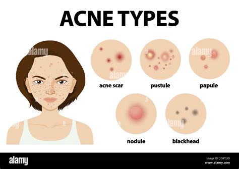 Different Types Of Acne