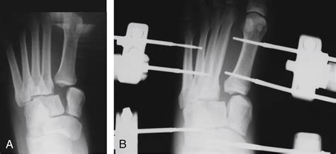 Open Reduction And Internal Fixation Of Fracture ­dislocations Of The Tarsometatarsal Joint