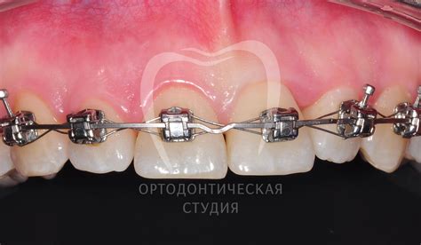Элементы брекет-системы: ортодонтические кольца, дуга, лигатуры ...