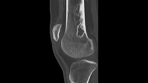 Nonossifying fibroma - wikidoc