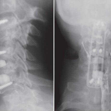 Second postsurgical urgent cervical CT. Recurring prevertebral hematoma ...