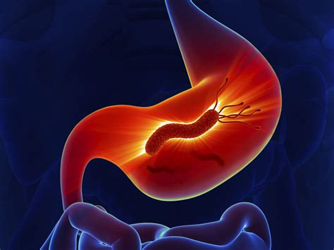 Гастрит: симптомы, признаки и лечение