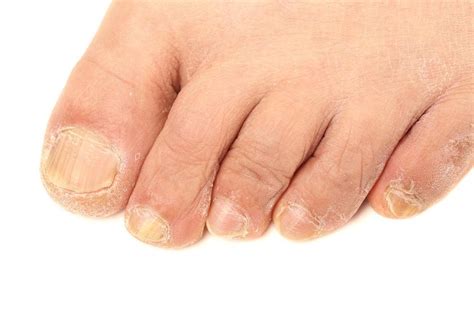 Get Rid Of Toenail Fungus Outlet