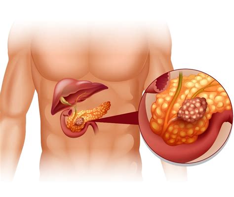 Tumore Neuroendocrino Pancreas Cos Sopravvivenza Terapia