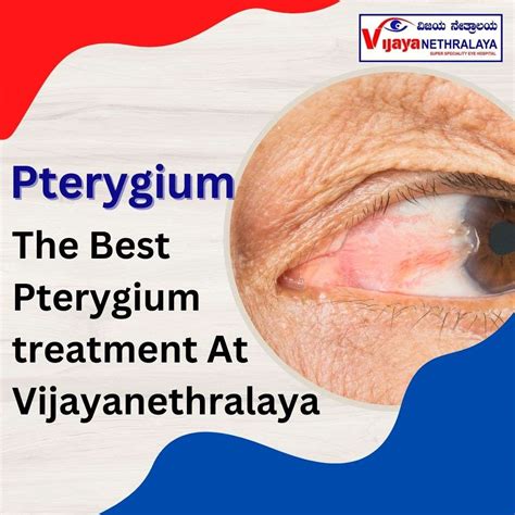 Pterygium Eye Treatment: Understanding Causes Symptoms