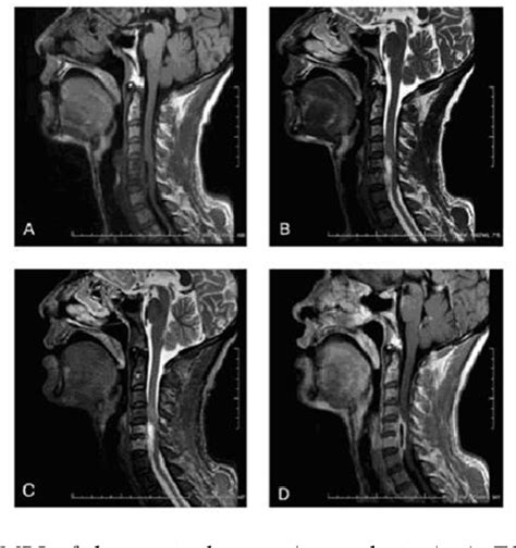 Figure 1 From Mri Characteristics Of Brucellar Spondylodiscitis In