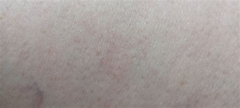Красные пятна Появились красные пятна на теле, разные по размеру и ...