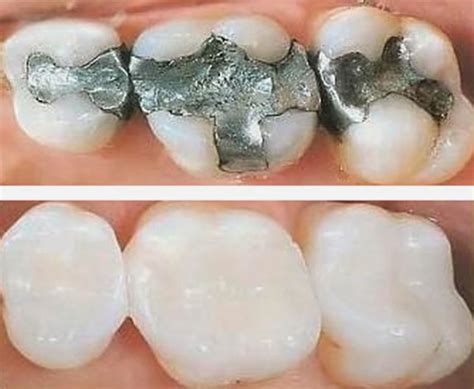 White Fillings White Tooth Fillings Abbotsfort Dental Clinic