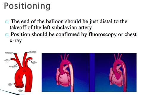 Intra Aortic Balloon Pump Iabp Positioning Balloon Pump Cardiac Rn