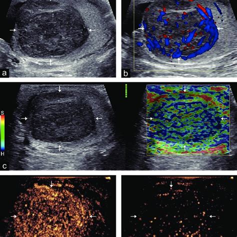 A 38 Year Old Male With A Right Testicular Seminoma A Grayscale US