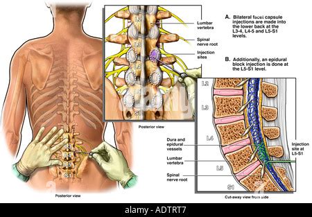 Lumbale Epidurale Injektion Stockfotografie Alamy