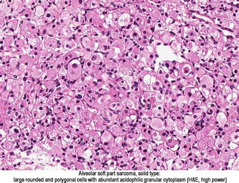 Pathology Outlines Alveolar Soft Part Sarcoma