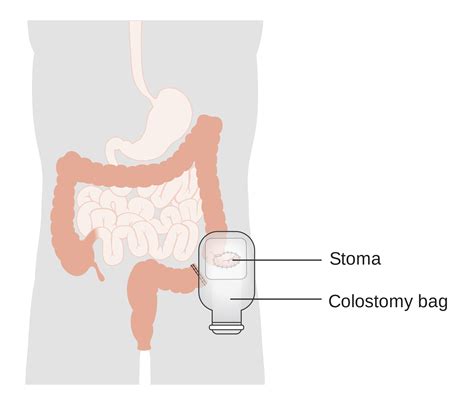 Déroulement De La Coloscopie Courte