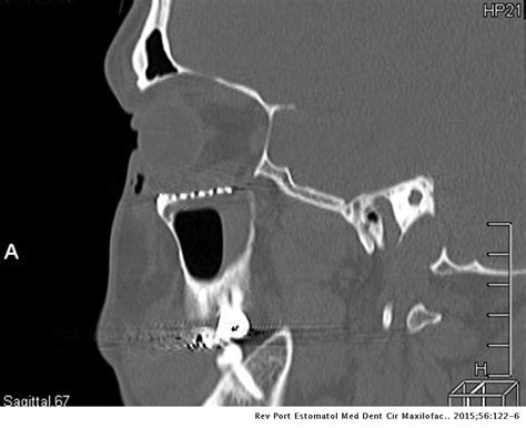 Reconstruction Of Orbital Floor For Treatment Of A Pure Blowout