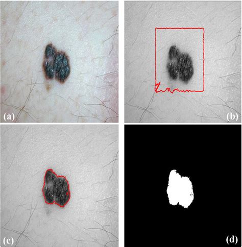 Fuzzy Entropy With Level Set Segmentation Of Dermoscopy Color Image For