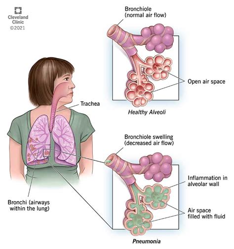 Identifying Aspiration Pneumonia Arc Of Monroe