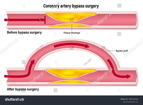 coronary artery bypass human heart blood stock vector royalty   shutterstock