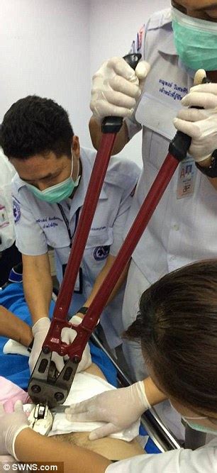 Thai Man Has A Sex Ring Removed With BOLTCUTTERS After It Became Stuck On His Penis Daily Mail