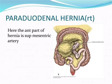 Internal Hernia Ppt