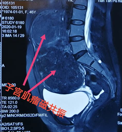 陈谦主任科普之海扶刀治疗子宫肌瘤病历 陈谦主治医师 爱问医生