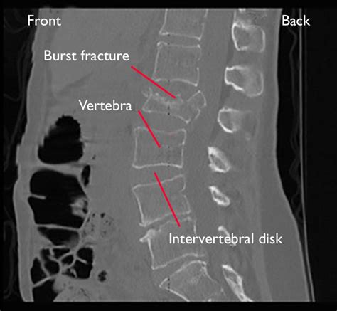 Fractures of the Thoracic and Lumbar Spine - OrthoInfo - AAOS