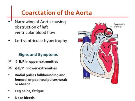 Pin by nonas arc on Coarctation of the Aorta | Coarctation of the aorta ...