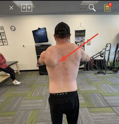 Scapular Dyskinesis Rxr Rehab Physical Therapy