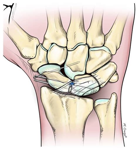 Arthroscopic Dorsal Capsuloligamentous Repair In The Treatment Of