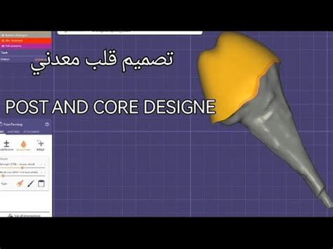 Post And Core Design By Exocad Youtube