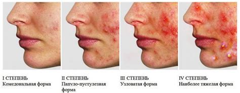 Виды прыщей на лице: виды, лечение