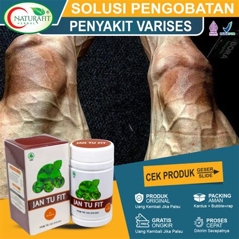 Obat Varises Paling Ampuh Obat Varises Di Kaki Pembengkakan Pembuluh