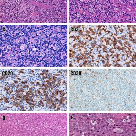 Numerous Immunoblasts In Reactive Paracortical Hyperplasia And