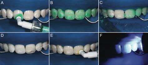 How To Treat Fluorosis Morning Huddle