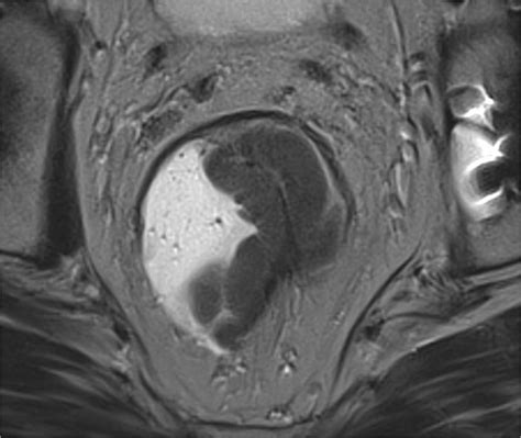 Axial High Resolution T2 Weighted Mr Image Of A 67 Year Old Man Showing