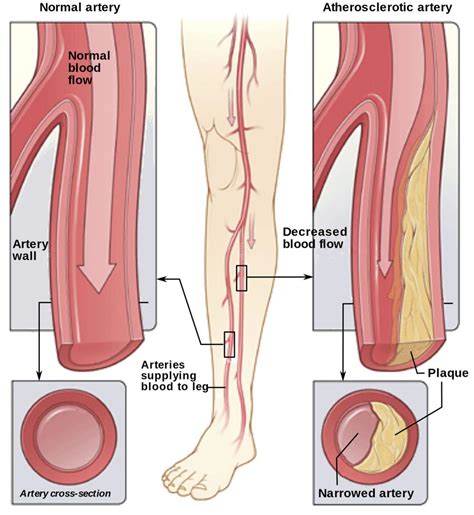 Peripheral Artery Disease Causes Symptoms Treatment