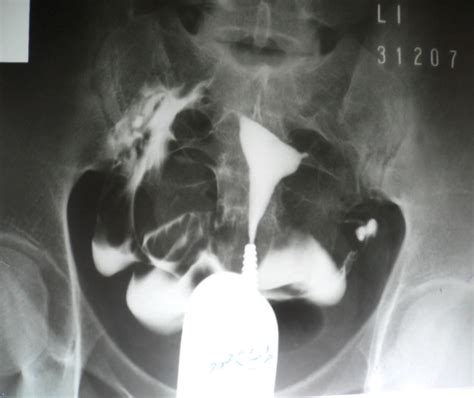 Figure 1 From Comparison Of Hysterosalpingography And Diagnostic