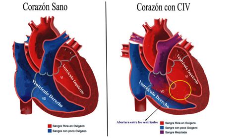 Por Primera Vez En Nicaragua Cirugía De La Comunicación Interventricular