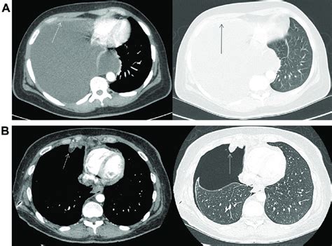 A Ct Imaging Showing Large Pleural Effusion With Possible Anterior Download Scientific