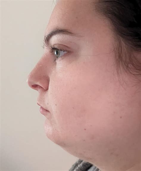 I have basically no top lip / unhappy with my lips in general. Filler