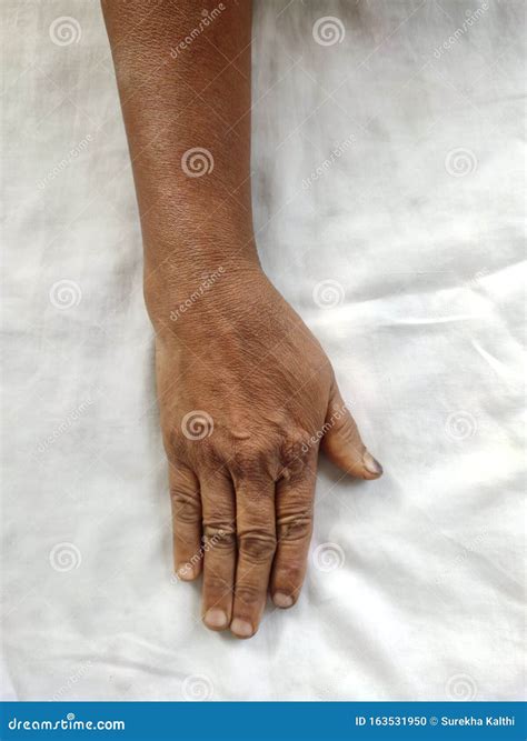 Dislocated Hand after Wrist Fracture Stock Photo - Image of orthopedic