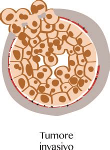 Cosa Significa B B Sulla Biopsia Mammaria Prof Massimo Vergine