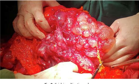 Figure 2 From Surgical Management Of A Benign Multicystic Peritoneal